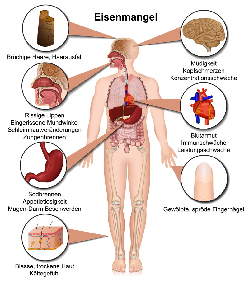Eisenmangel_Bild - Vorteilhaft Leben - Vorteilhaft Leben