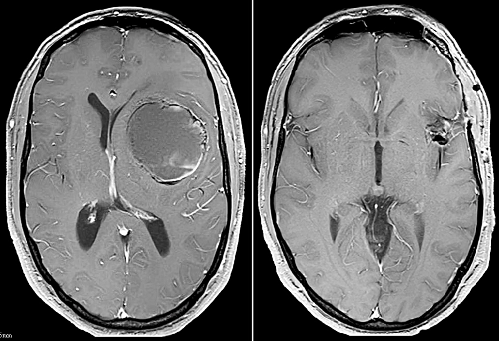 Hirntumor - Vorteilhaft Leben - Vorteilhaft Leben